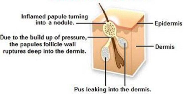 Acne Nodules Treatment