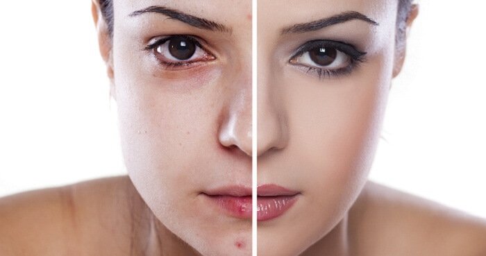 Acne Treatment For Teenagers