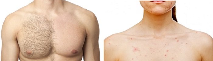 Treating Acne on Chest