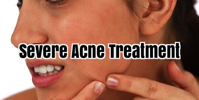 Severe Acne Treatment