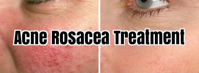 Acne Rosacea Treatment