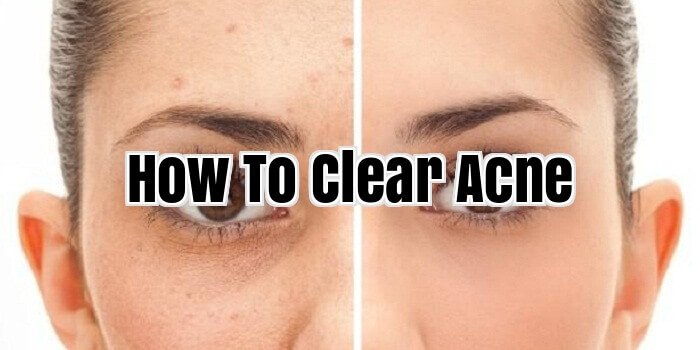 How To Clear Acne