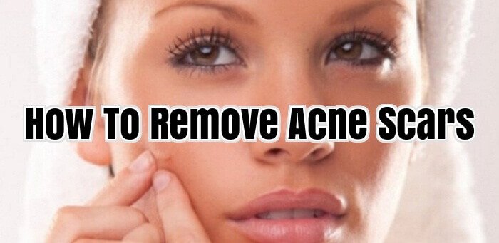 How To Remove Acne Scars