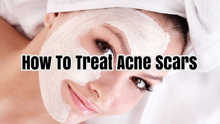 How To Treat Acne Scars