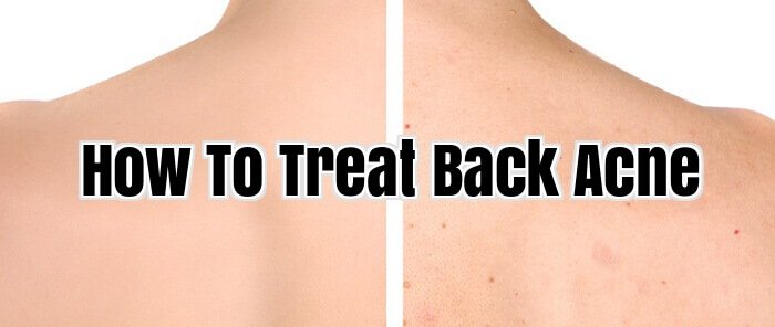 How To Treat Back Acne
