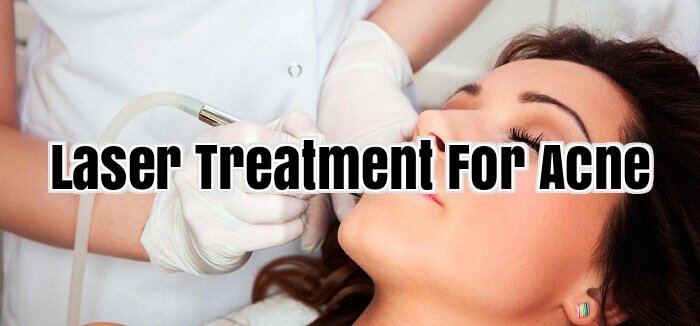 Laser Treatment For Acne