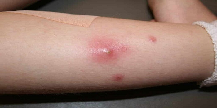 3 Boils Treatment for Fast Relief