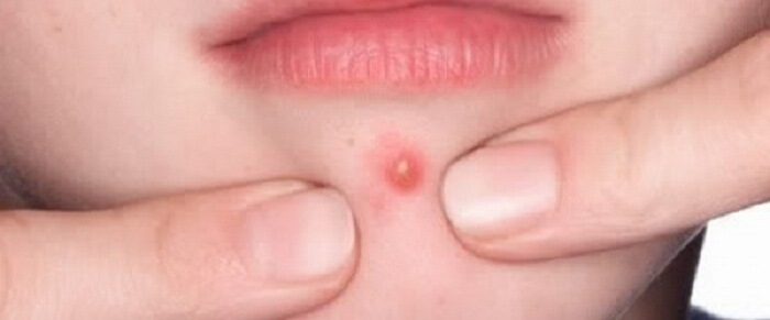 Home Remedies For A Boil