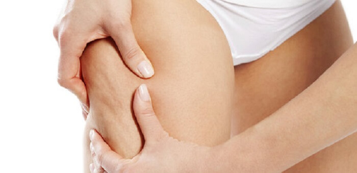 Cellulite Treatment Options