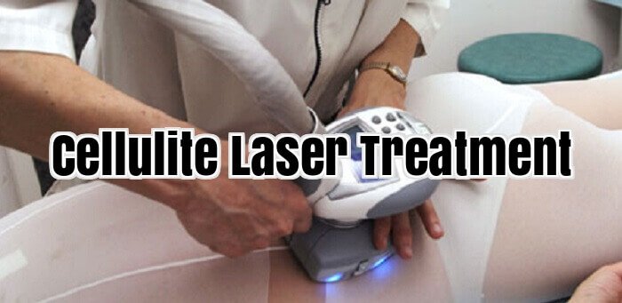 Cellulite Laser Treatment