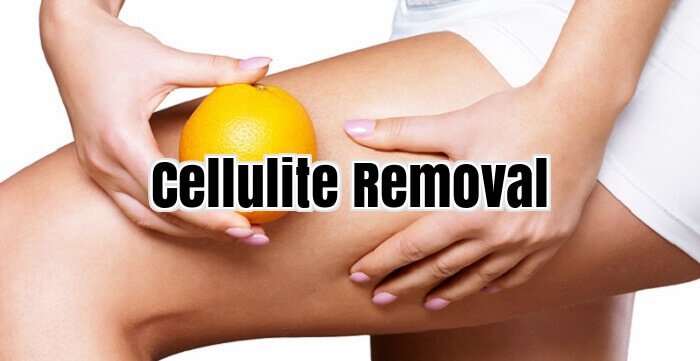 Cellulite Removal