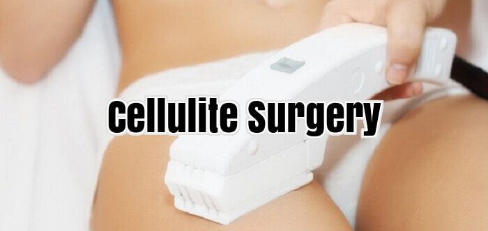 Cellulite Surgery