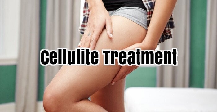 Cellulite Treatment