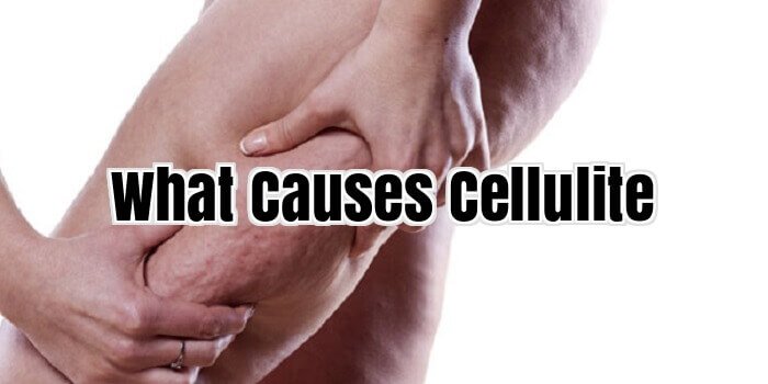What Causes Cellulite