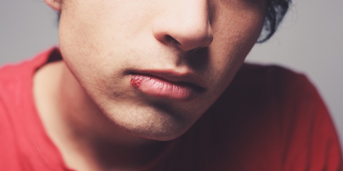 Best Cold Sore Medication Treatment For Men