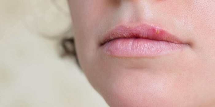 Cold Sore Treatments