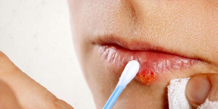 Discover 5 Great Cold Sore Treatments That Are Totally Free