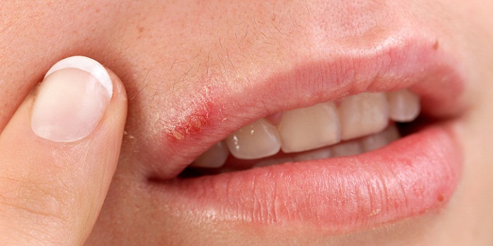 Eliminate Cold Sores Now