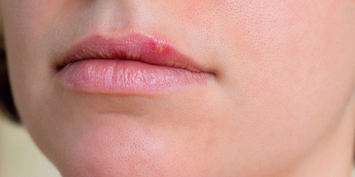 How To Get Rid Of Cold Sores Quickly