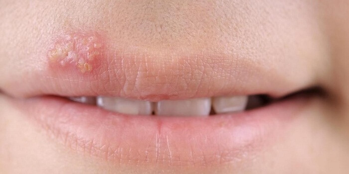 Simple And Easy Cold Sore Treatments You May Not Heard Of