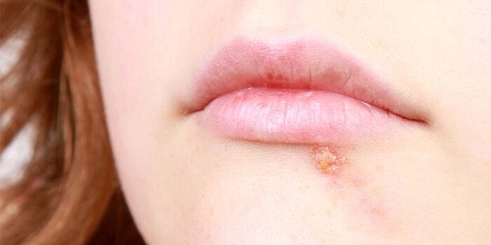 Tips on Cold Sore Treatments