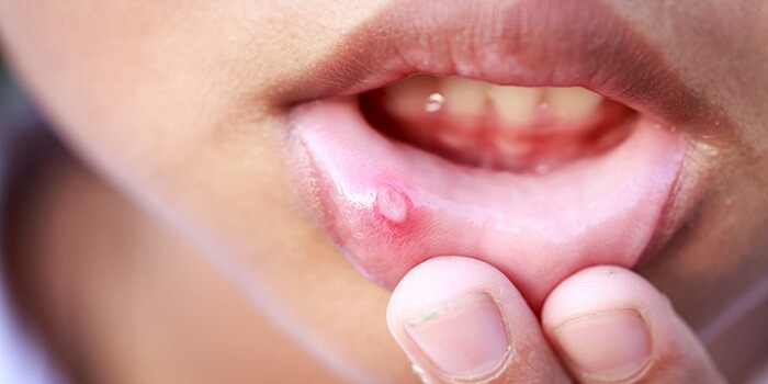 Treatments For Cold Sores Inside Mouth