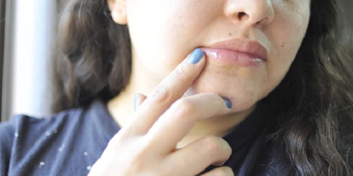 What are the stages of a Cold Sore