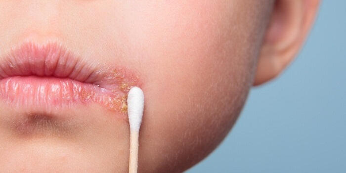What’s The Best Cold Sore Treatment