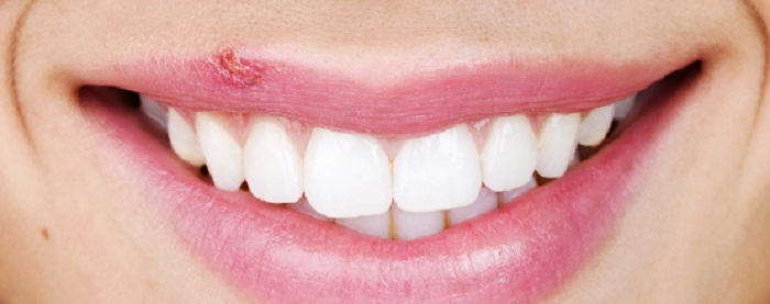 Home Remedy Cold Sore