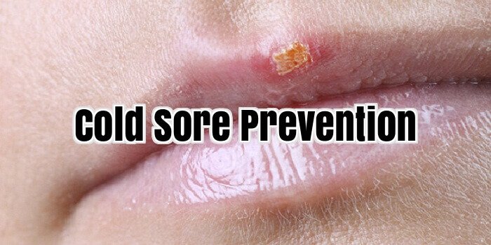 Cold Sore Prevention
