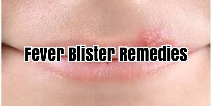 Fever Blister Remedies