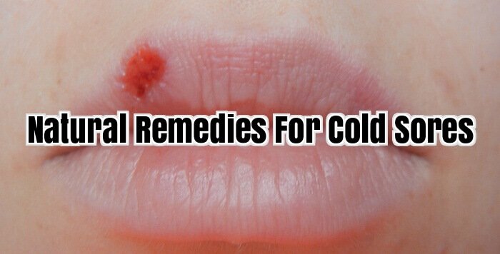 Natural Remedies For Cold Sores