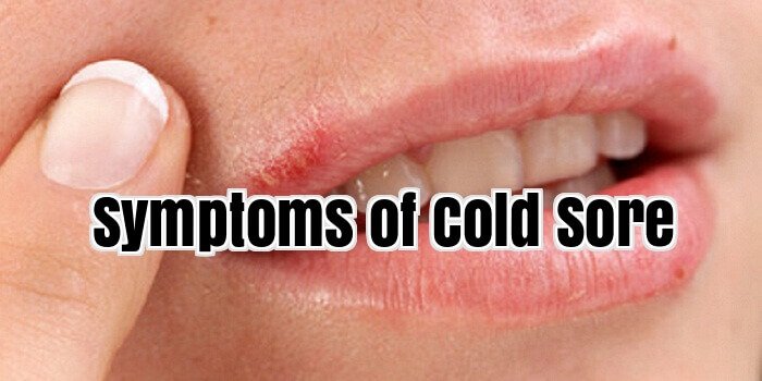 Symptoms of Cold Sore