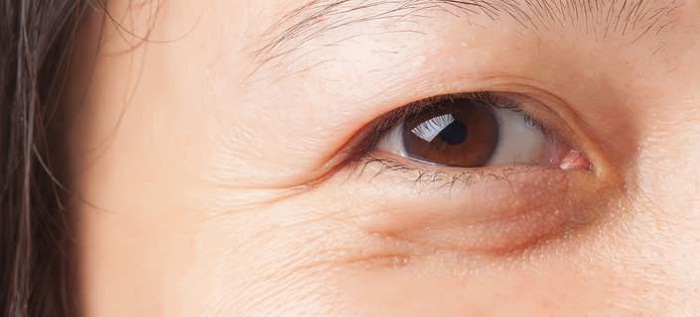 How To Prevent Wrinkles And Under Eye Bags