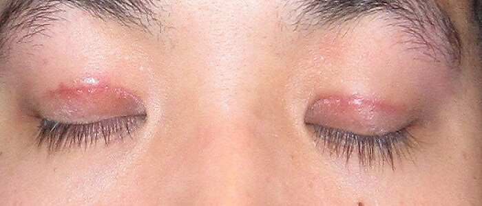 Get Treated Under Eye Skin Problems With Our Popular Eye Creams