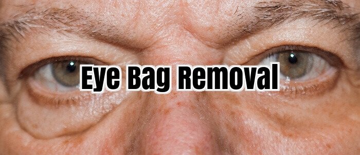 Eye Bag Removal