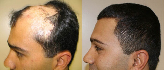 https://www.healthplantotal.com/images/hairloss-images/home/hair-regrowth-in-men.jpg