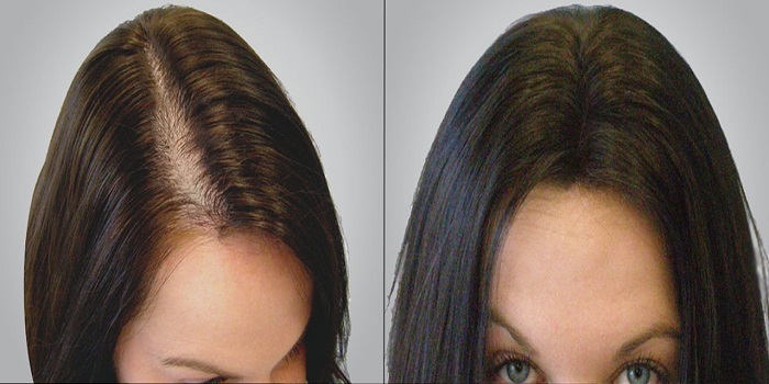 How To Reverse Hair Loss And Grow It Back