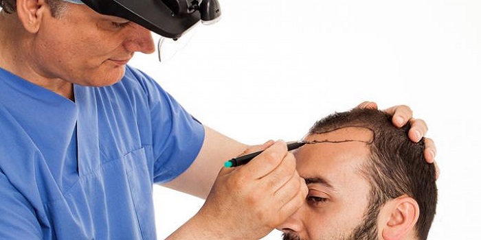 A Male Hair Loss Treatment Without The Risk