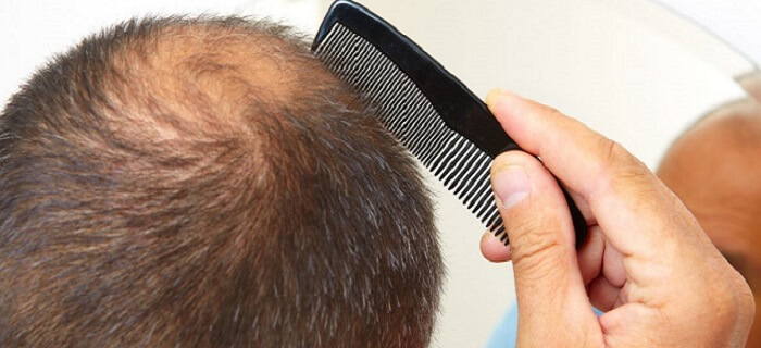 New Hair Loss Treatments