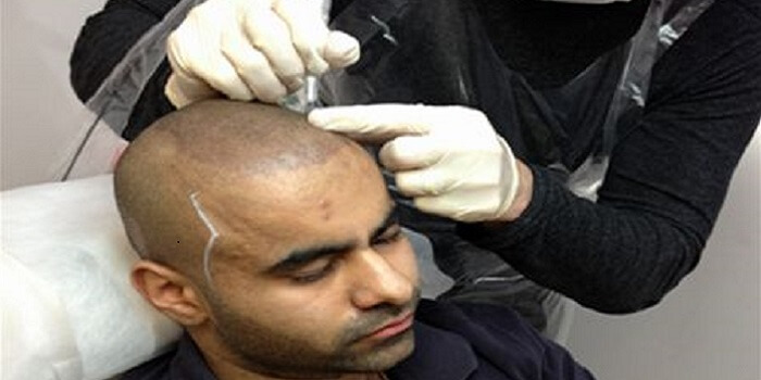 Surgical Hair Loss Treatments