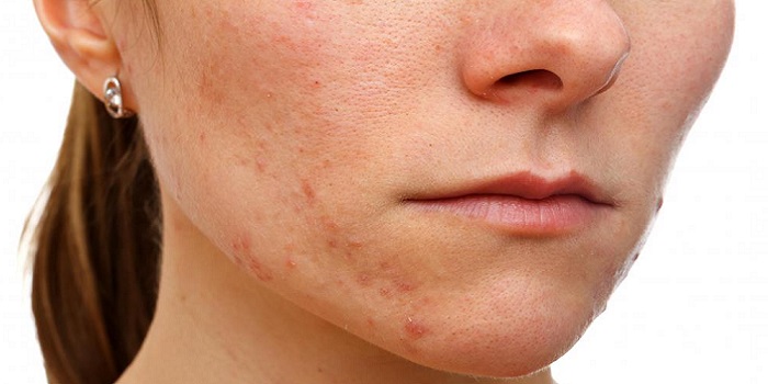 Hair Removal Cream Side Effects