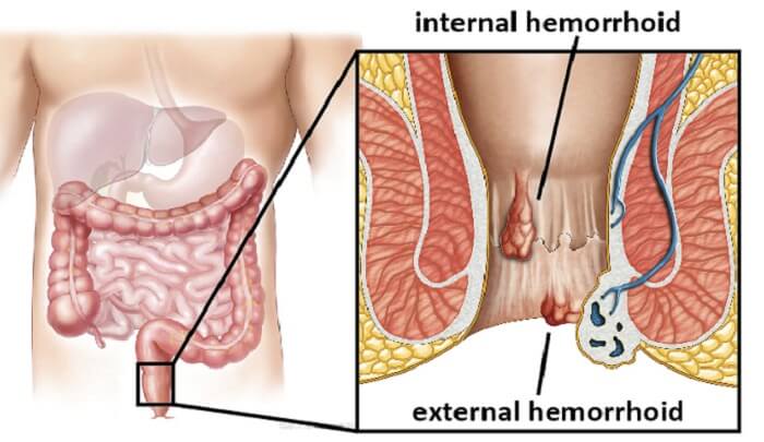Home Remedies For Hemorrhoids