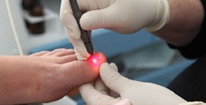 Laser Treatment For Toenail Fungus