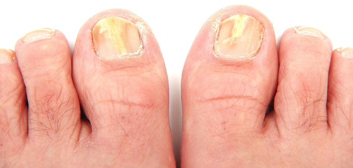 Treatment For Fungal Nail Infection
