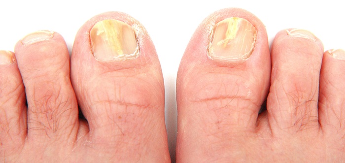 Nail Fungus Treatment Selections
