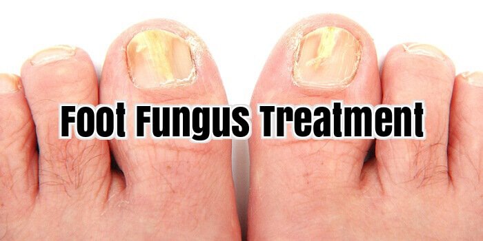 Foot Fungus Treatment