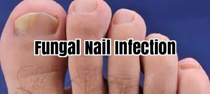 Fungal Nail Infection