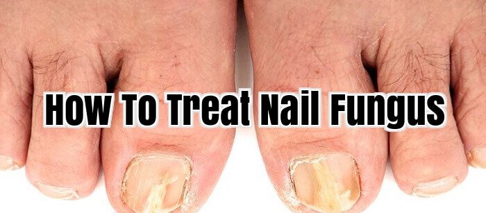 How To Treat Nail Fungus