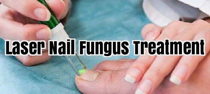 Laser Nail Fungus Treatment